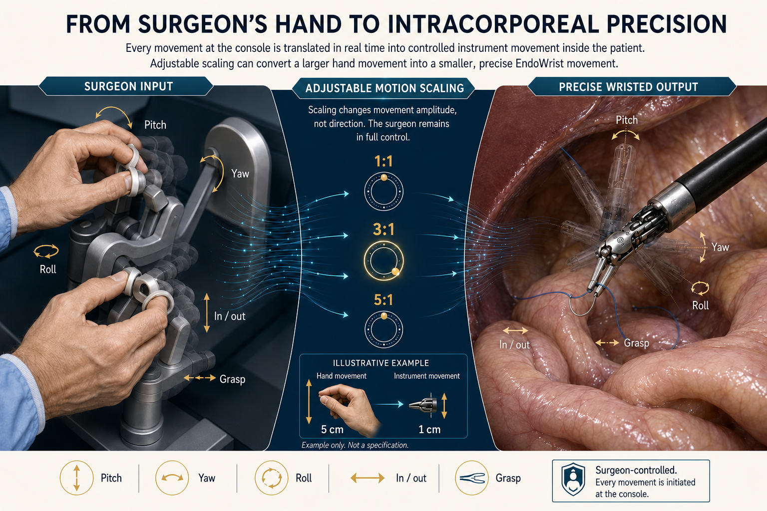 Surgeon hand movements at a robotic console translated through adjustable motion scaling into precise wristed instrument movements inside the abdominal cavity